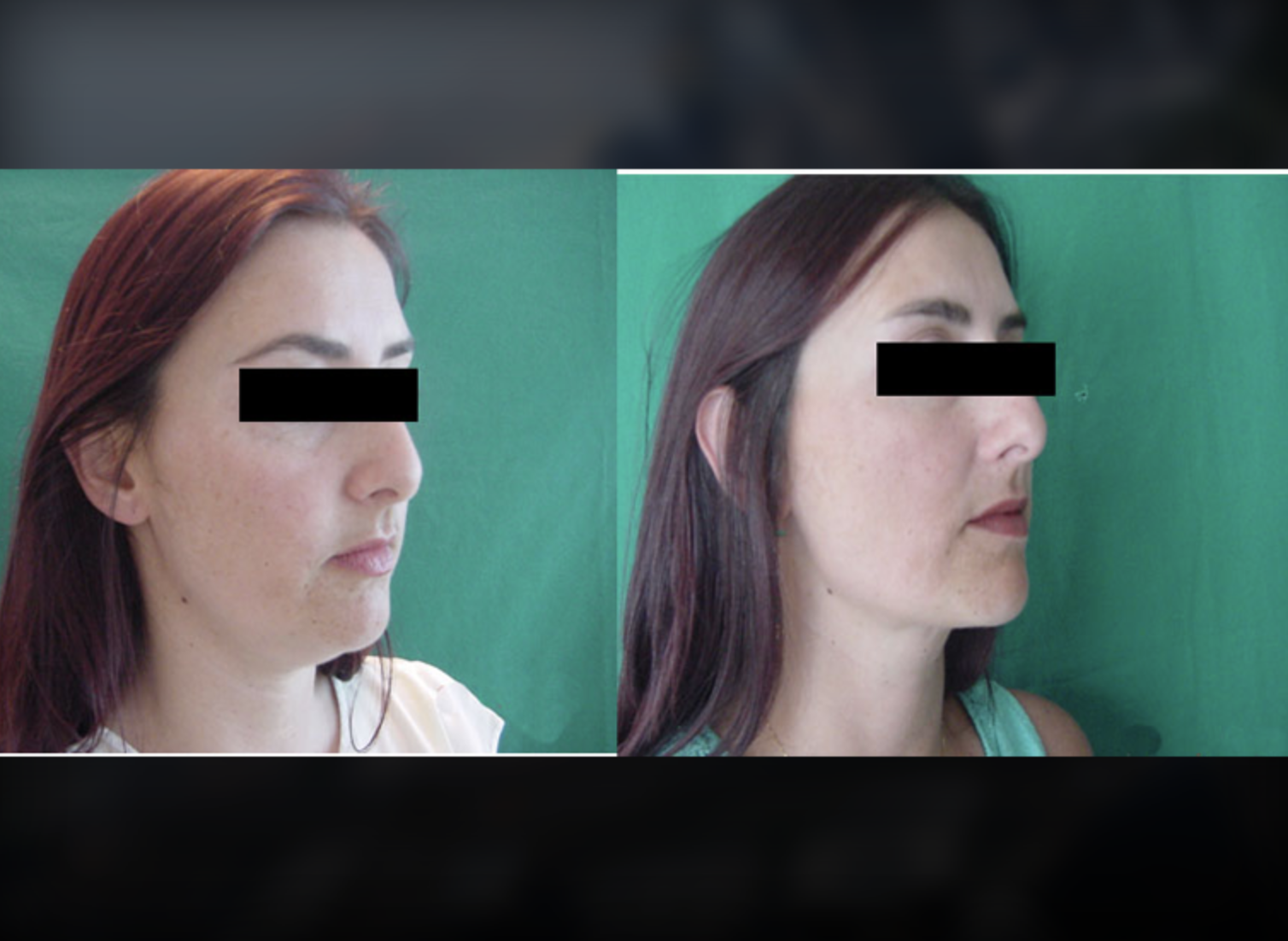 Neck & Chin before and after